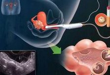 小茴香大茴香要分清，试管移植后可以吃茴香但不宜过量！